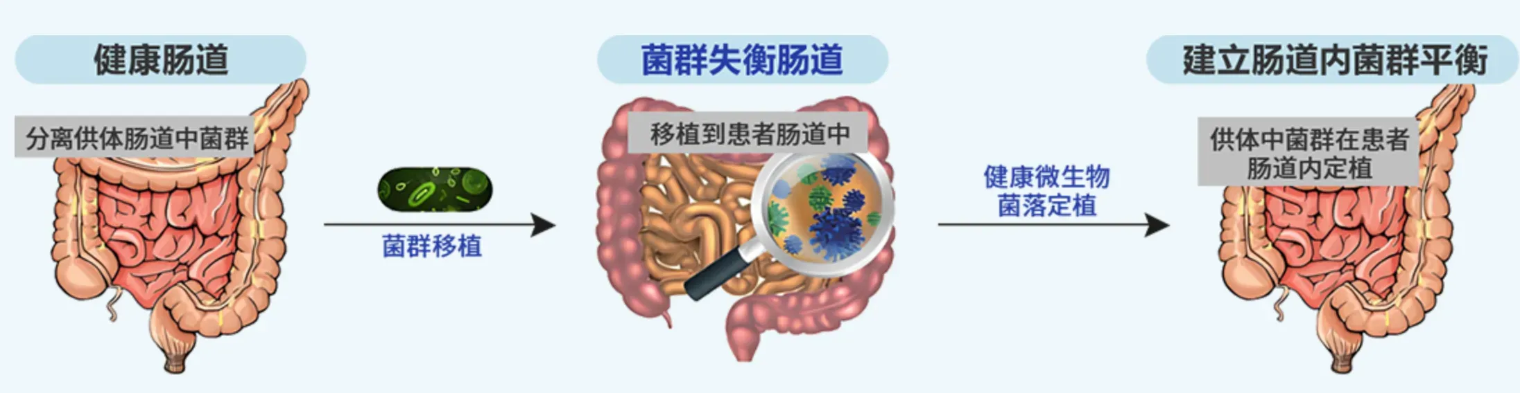 合康谱肠道菌群移植流程（示意）